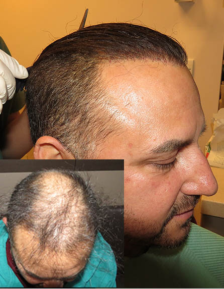 Biofibre Synthetic Hair Implant in Pune - Cost, Results